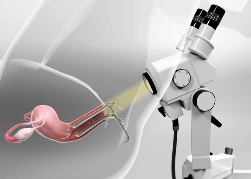 Colposcopy and Cervical Biopsy Procedure