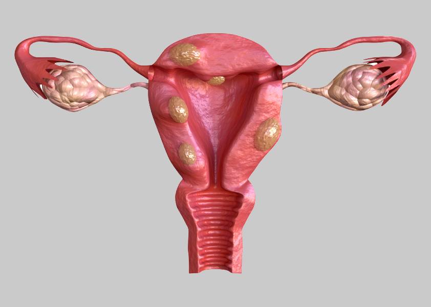 Uterine Fibroids Treatment in Hinjewadi