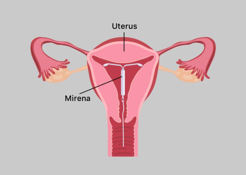 Mirena Hormonal IUD Benefits and Side Effect