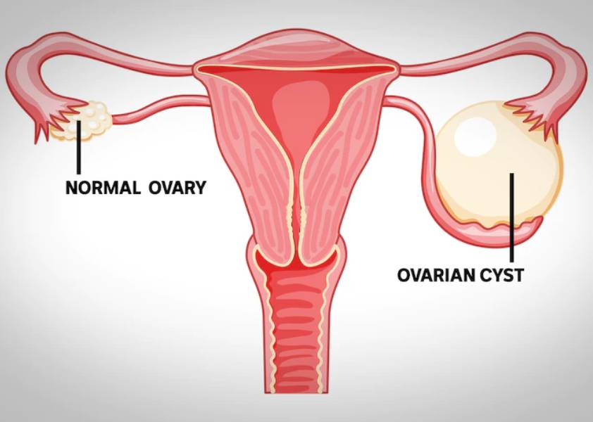 Ovarian Cysts Diagnosis And Treatment in Hinjewadi